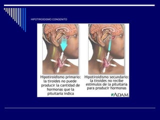 HIPOTIROIDISMO CONGENITO 