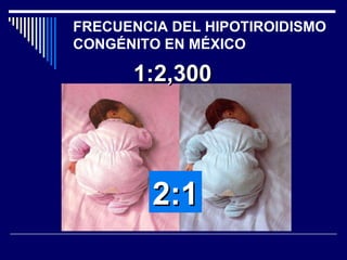 FRECUENCIA DEL HIPOTIROIDISMO CONGÉNITO EN MÉXICO 1:2,300 2:1 