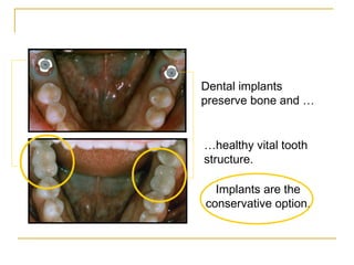 Dental implants 
preserve bone and … 
…healthy vital tooth 
structure. 
Implants are the 
conservative option. 
 