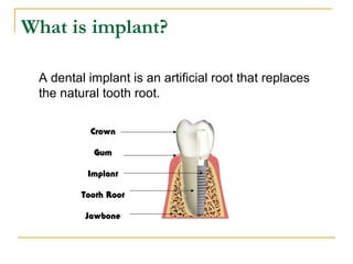 What is implant? 
A dental implant is an artificial root that replaces 
the natural tooth root. 
Crown 
Gum 
Implant 
Tooth Root 
Jawbone 
 