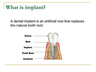 What is implant? 
A dental implant is an artificial root that replaces 
the natural tooth root. 
Crown 
Gum 
Implant 
Toot...