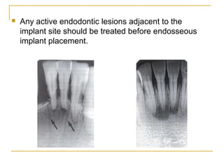  Any active endodontic lesions adjacent to the 
implant site should be treated before endosseous 
implant placement. 
 