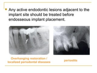  Any active endodontic lesions adjacent to the 
implant site should be treated before 
endosseous implant placement. 
Overhanging restoration / 
localized periodontal diseases periostits 
 