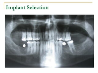 Implant Selection 
 