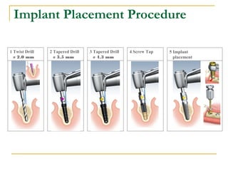 Implant Placement Procedure 
4 Screw Tap 5 Implant 
placement 
2 Tapered Drill 
ø 3.5 mm 
3 Tapered Drill 
ø 4.3 mm 
1 Twist Drill 
ø 2.0 mm 
 