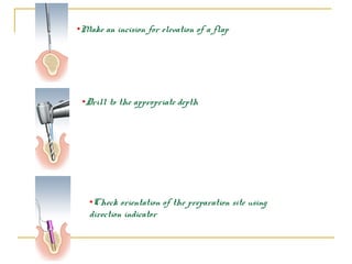 •Make an incision for elevation of a flap 
•Drill to the appropriate depth 
•Check orientation of the preparation site using 
direction indicator 
 