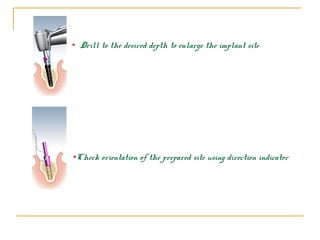 • Drill to the desired depth to enlarge the implant site 
•Check orientation of the prepared site using direction indicator 
 