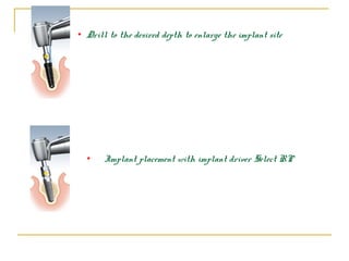 • Drill to the desired depth to enlarge the implant site 
• Implant placement with implant driver Select RP 
 