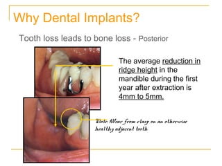Why Dental Implants? 
Tooth loss leads to bone loss - Posterior 
The average reduction in 
ridge height in the 
mandible during the first 
year after extraction is 
4mm to 5mm. 
Note: Wear from clasp on an otherwise 
healthy adjacent tooth 
 