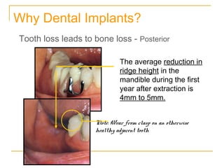 Why Dental Implants? 
Tooth loss leads to bone loss - Posterior 
The average reduction in 
ridge height in the 
mandible d...