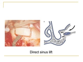 Direct sinus lift 
 