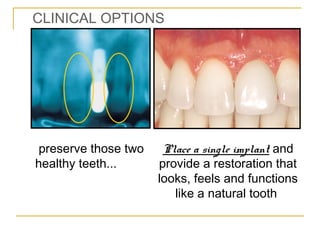 CLINICAL OPTIONS 
preserve those two 
healthy teeth... 
Place a single implant and 
provide a restoration that 
looks, feels and functions 
like a natural tooth 
 