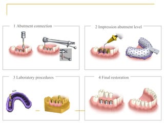 1 Abutment connection 2 Impression abutment level 
3 Laboratory procedures 4 Final restoration 
 