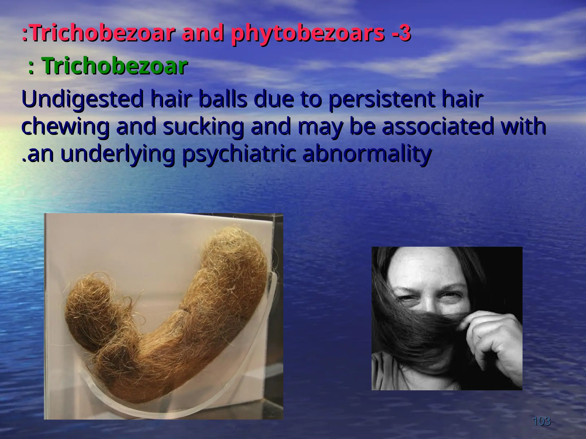 3
3
-
-
Trichobezoar and phytobezoars
Trichobezoar and phytobezoars
:
:
Trichobezoar
Trichobezoar
:
:
Undigested hair balls due to persistent hair
Undigested hair balls due to persistent hair
chewing and sucking and may be associated with
chewing and sucking and may be associated with
an underlying psychiatric abnormality
an underlying psychiatric abnormality
.
.
103
103
 
