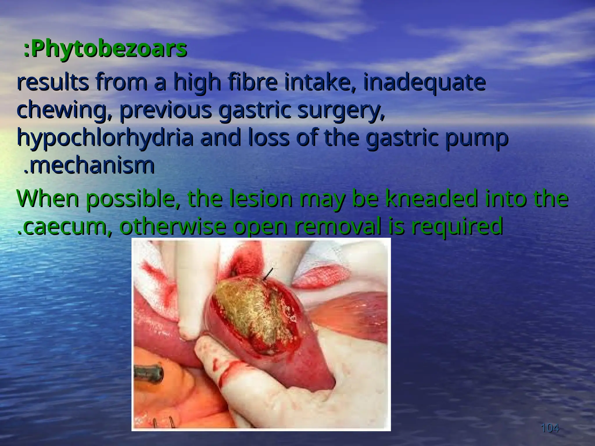 Phytobezoars
Phytobezoars
:
:
results from a high fibre intake, inadequate
results from a high fibre intake, inadequate
chewing, previous gastric surgery,
chewing, previous gastric surgery,
hypochlorhydria and loss of the gastric pump
hypochlorhydria and loss of the gastric pump
mechanism
mechanism
.
.
When possible, the lesion may be kneaded into the
When possible, the lesion may be kneaded into the
caecum, otherwise open removal is required
caecum, otherwise open removal is required
.
.
104
104
 