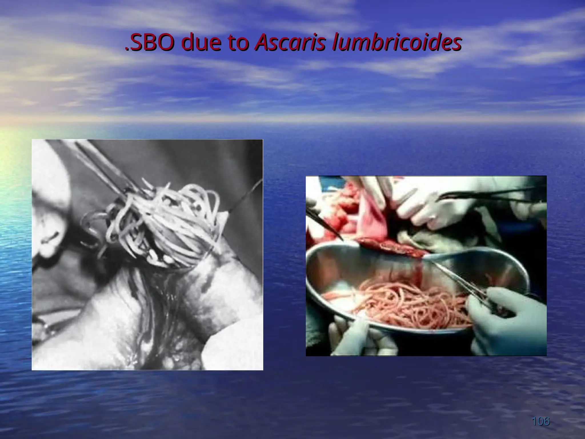 SBO due to
SBO due to Ascaris lumbricoides
Ascaris lumbricoides
.
.
106
106
 