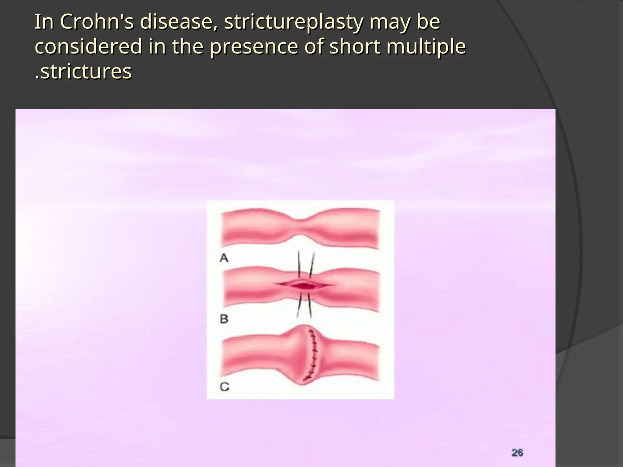 In Crohn's disease, strictureplasty may be
In Crohn's disease, strictureplasty may be
considered in the presence of short multiple
considered in the presence of short multiple
strictures
strictures
.
.
 