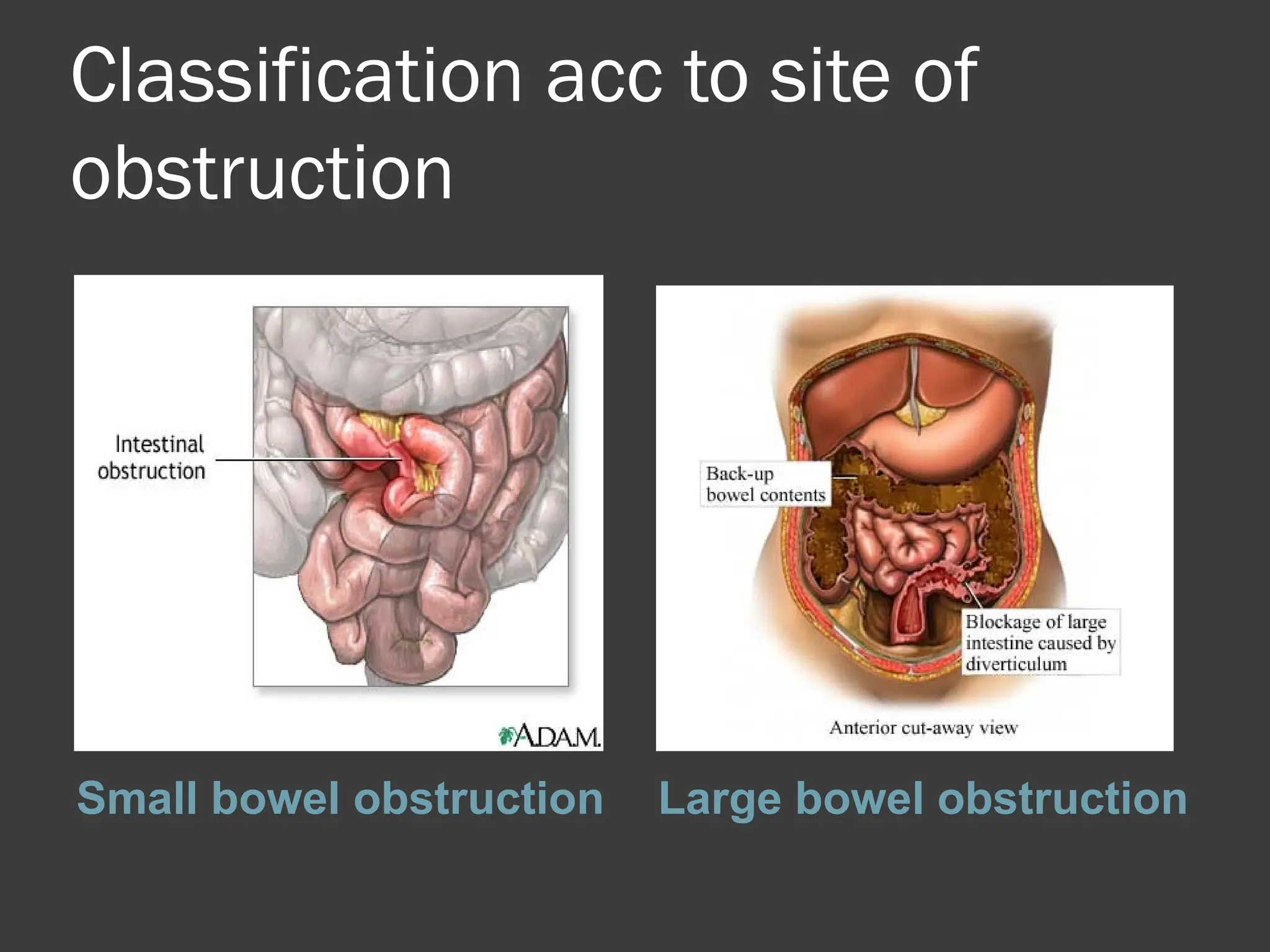 Classification acc to site of
obstruction
Small bowel obstruction Large bowel obstruction
 