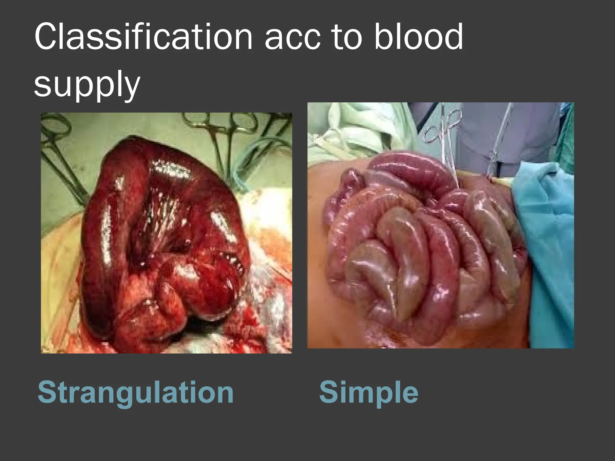 Classification acc to blood
supply
Strangulation Simple
 