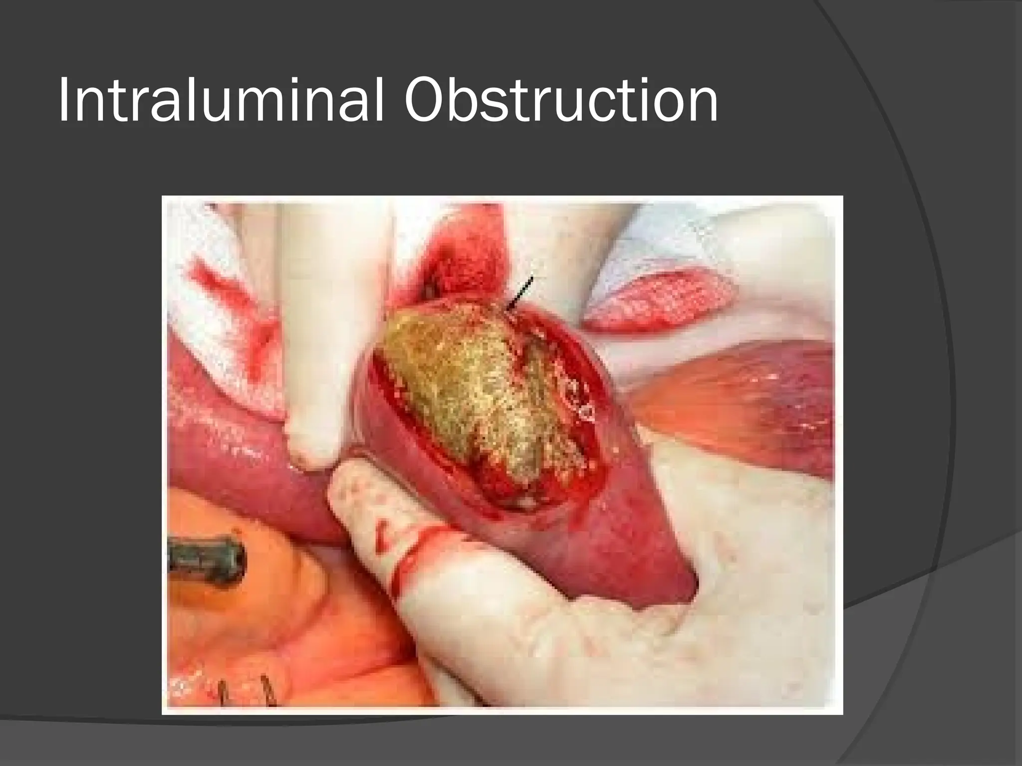 Intraluminal Obstruction
 