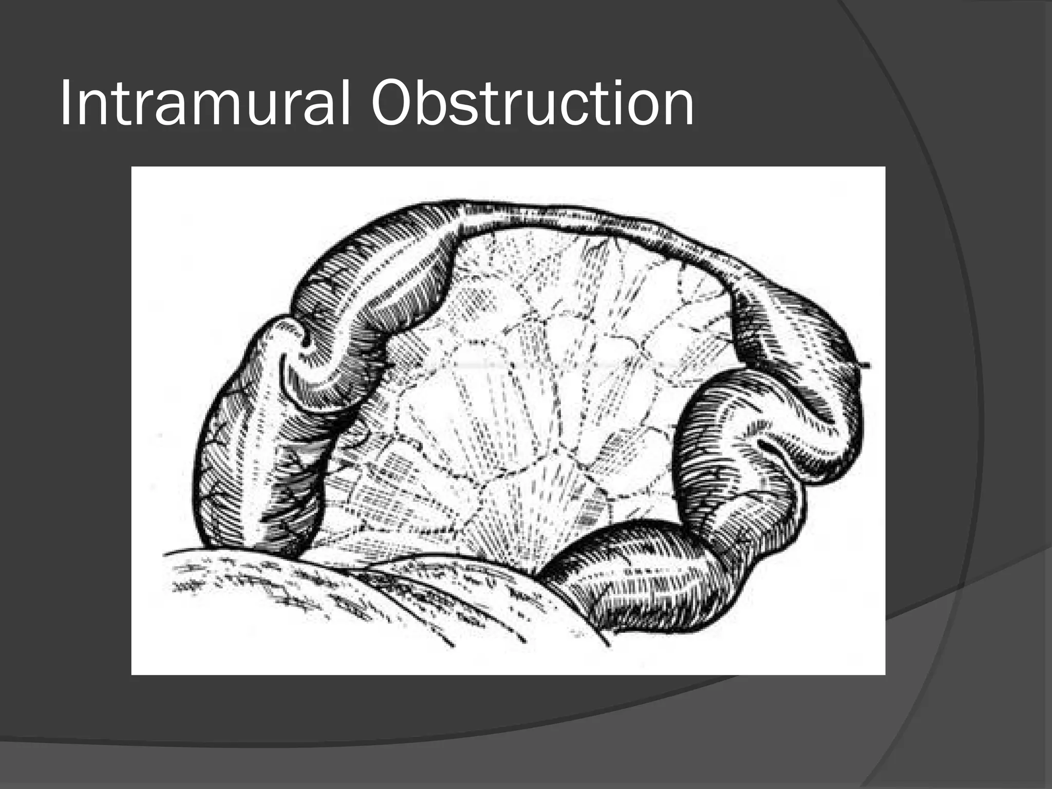 Intramural Obstruction
 