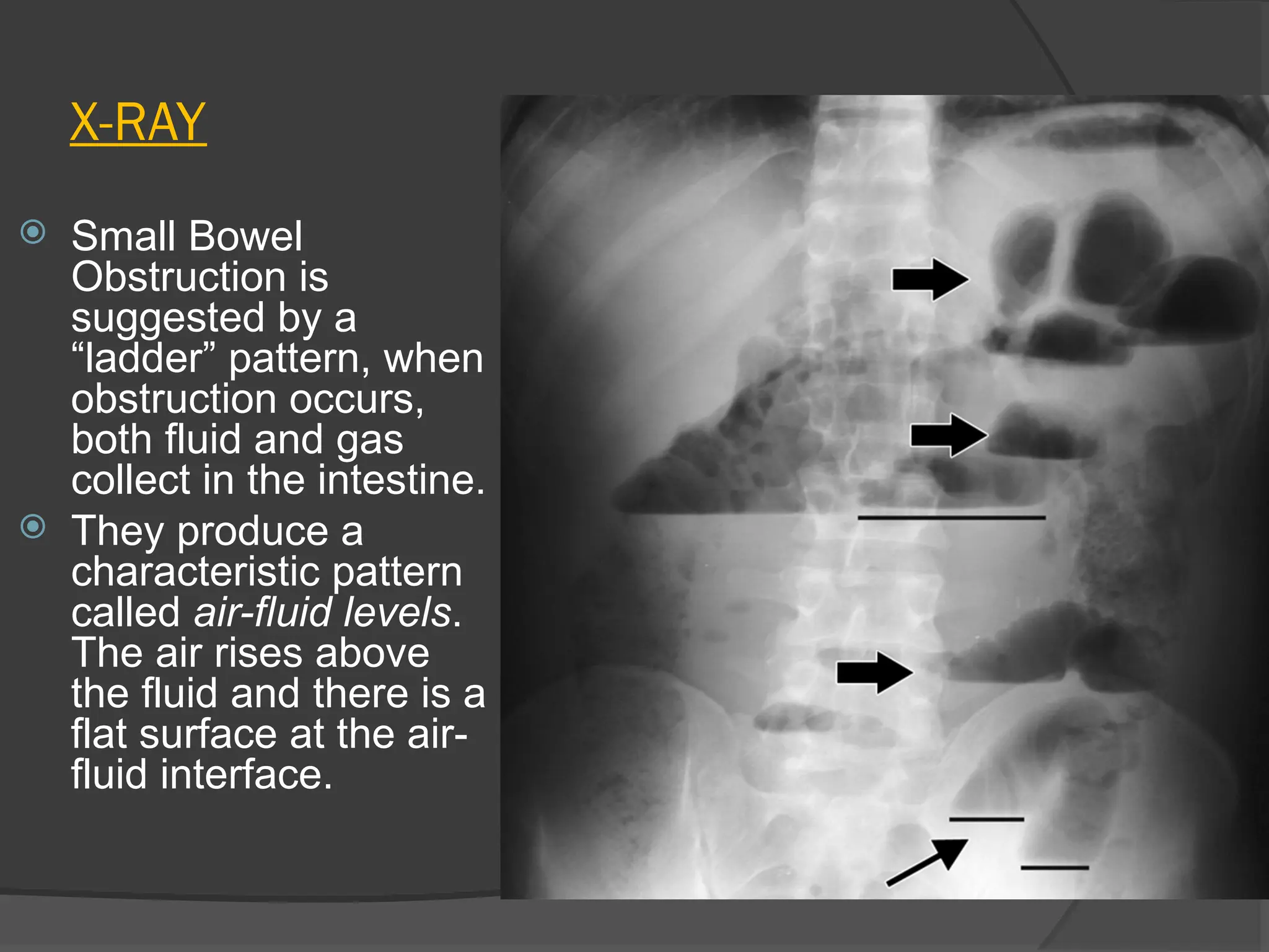 X-RAY
 Small Bowel
Obstruction is
suggested by a
“ladder” pattern, when
obstruction occurs,
both fluid and gas
collect in the intestine.
 They produce a
characteristic pattern
called air-fluid levels.
The air rises above
the fluid and there is a
flat surface at the air-
fluid interface.
 