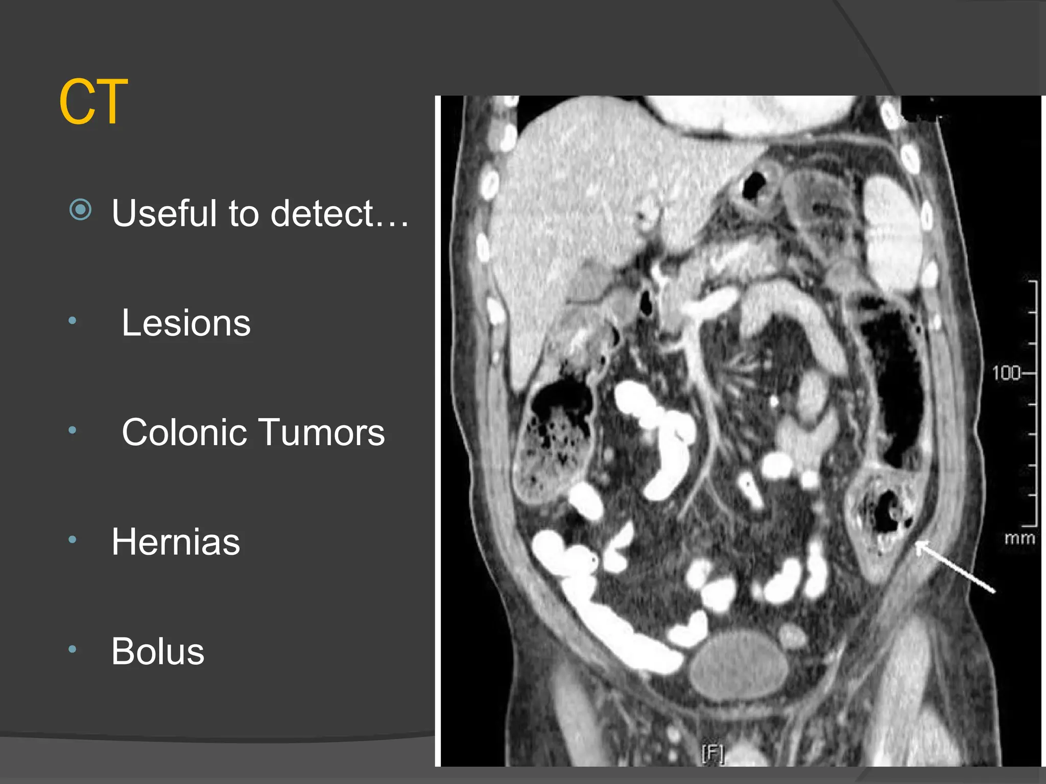 CT
 Useful to detect…
• Lesions
• Colonic Tumors
• Hernias
• Bolus
 