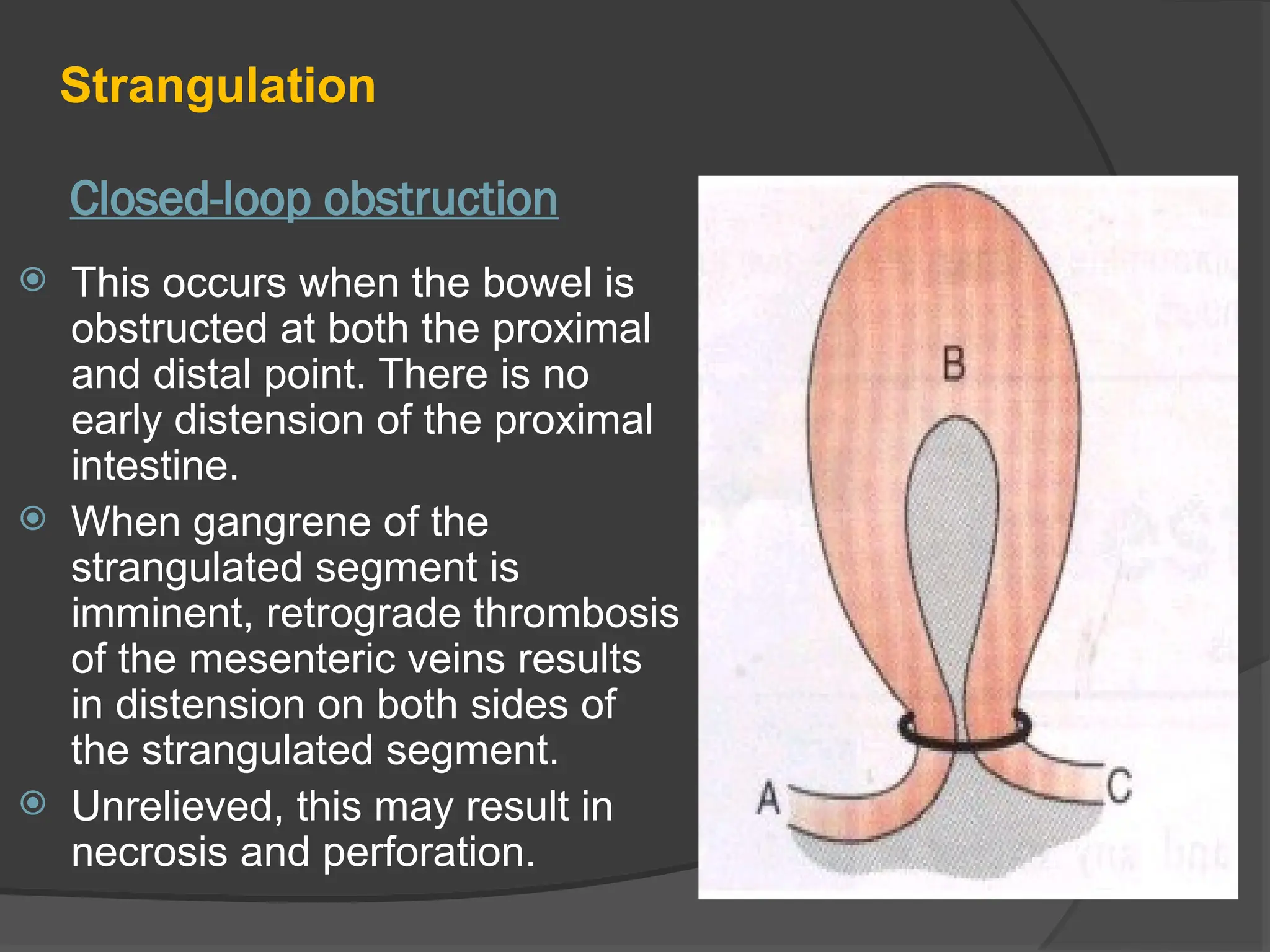 Closed-loop obstruction
Strangulation
 This occurs when the bowel is
obstructed at both the proximal
and distal point. There is no
early distension of the proximal
intestine.
 When gangrene of the
strangulated segment is
imminent, retrograde thrombosis
of the mesenteric veins results
in distension on both sides of
the strangulated segment.
 Unrelieved, this may result in
necrosis and perforation.
 