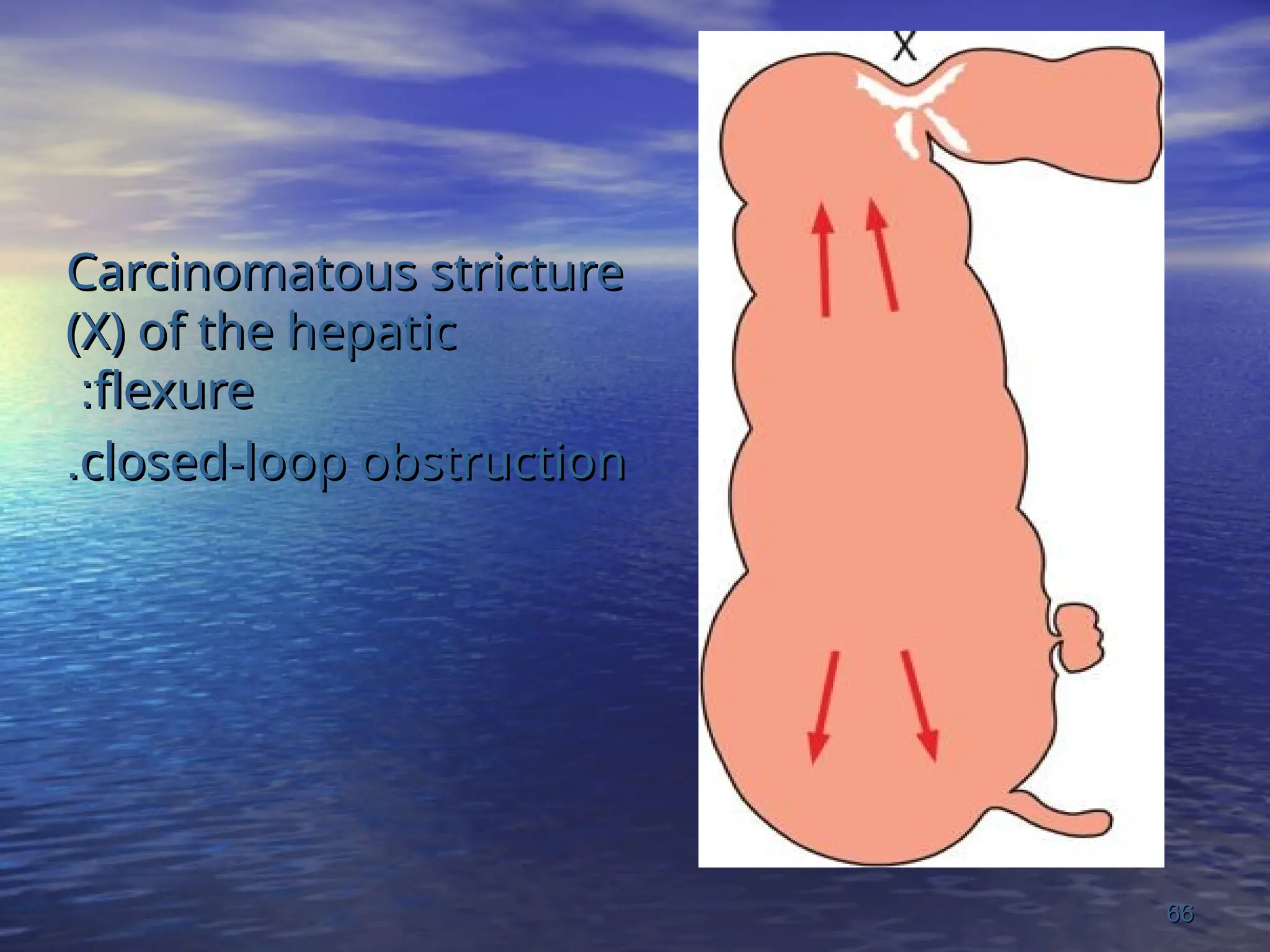 Carcinomatous stricture
Carcinomatous stricture
(X) of the hepatic
(X) of the hepatic
flexure
flexure
:
:
closed-loop obstruction
closed-loop obstruction
.
.
66
66
 
