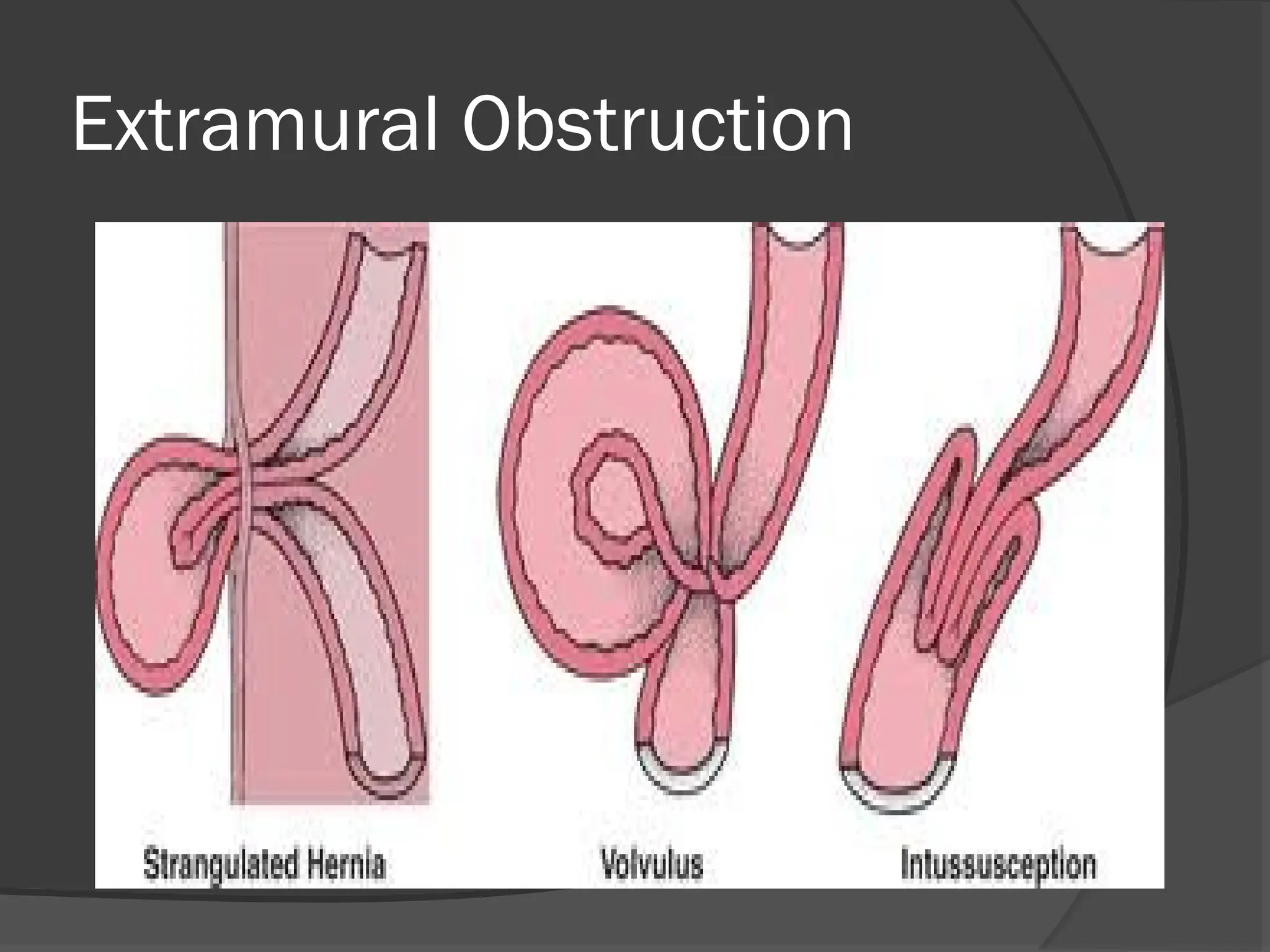 Extramural Obstruction
 