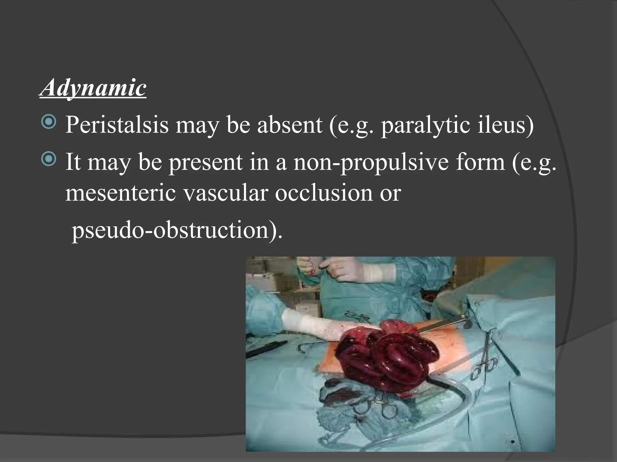 Adynamic
 Peristalsis may be absent (e.g. paralytic ileus)
 It may be present in a non-propulsive form (e.g.
mesenteric vascular occlusion or
pseudo-obstruction).
 