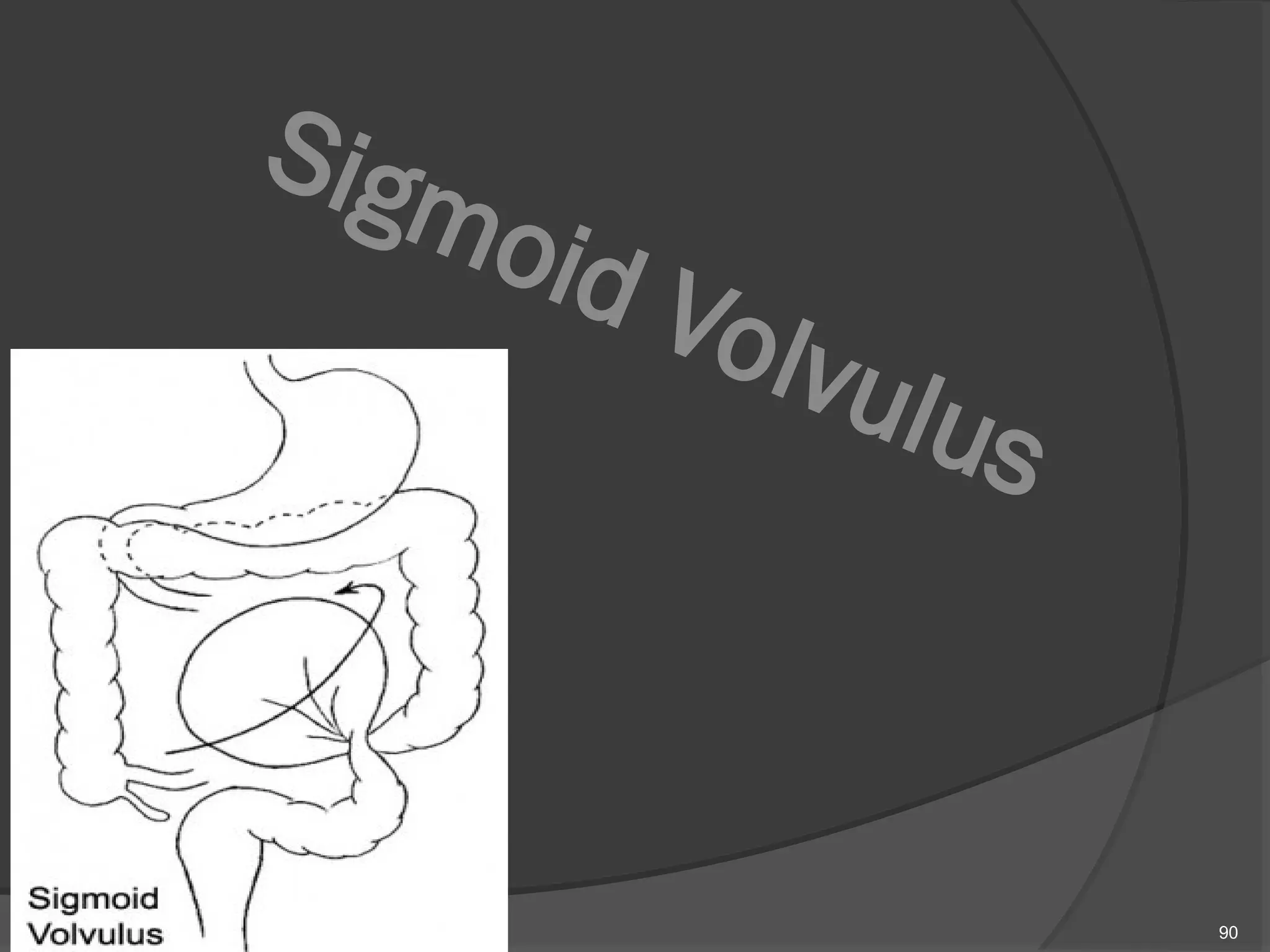 Sigmoid Volvulus
90
 