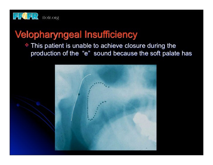 19 new speech And Velopharyngeal Function
