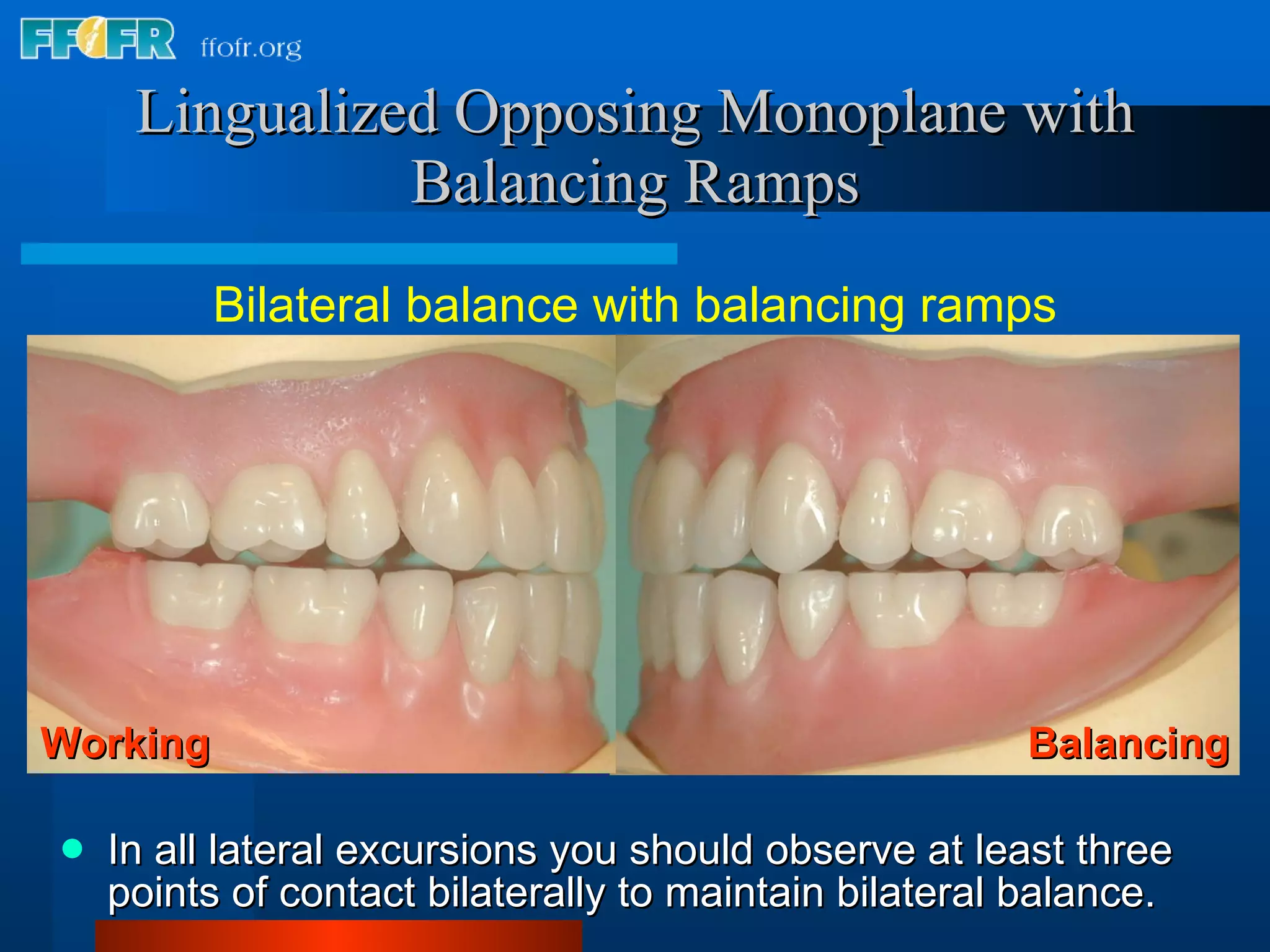 19. occlusal schemes lingualizied oposing monoplane with balancing ...
