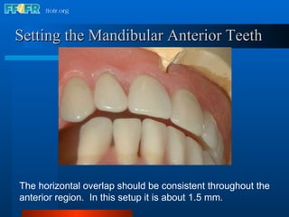 19. occlusal schemes lingualizied oposing monoplane with balancing ...