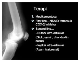 Osteoarthritis Refrat | PDF