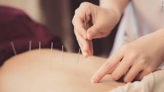Physiotherapist performs acupuncture on the back of a patient
