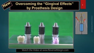 Overcoming the “Gingival Effects”
by Prosthesis Design
1
Watch the Video at www.ReverseMargin.com
 