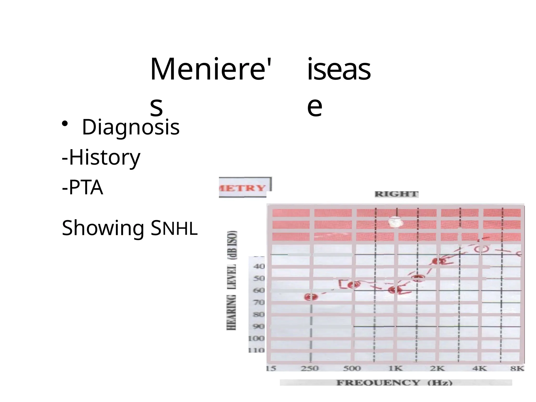 Meniere'
s
iseas
e
• Diagnosis
-History
-PTA
Showing SNHL
 