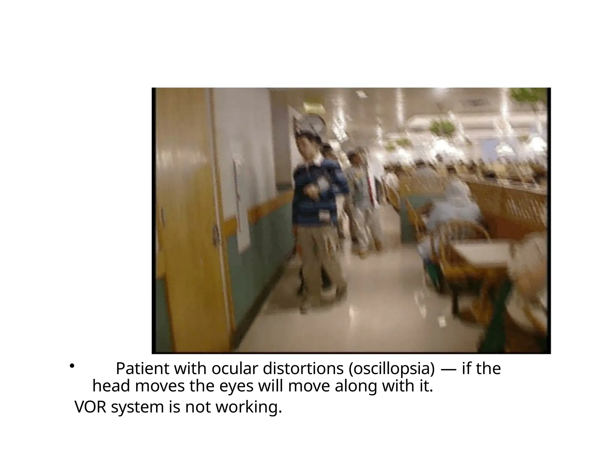 • Patient with ocular distortions (oscillopsia) — if the
head moves the eyes will move along with it.
VOR system is not working.
 