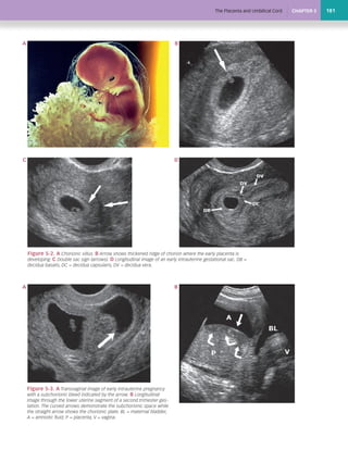 Chorionic Ridge 193656406 ultrasound-in-obstretics | PDF