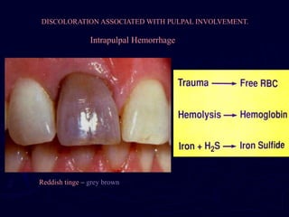 Pulp Bleeding Color 19387634-Discoloration.ppt