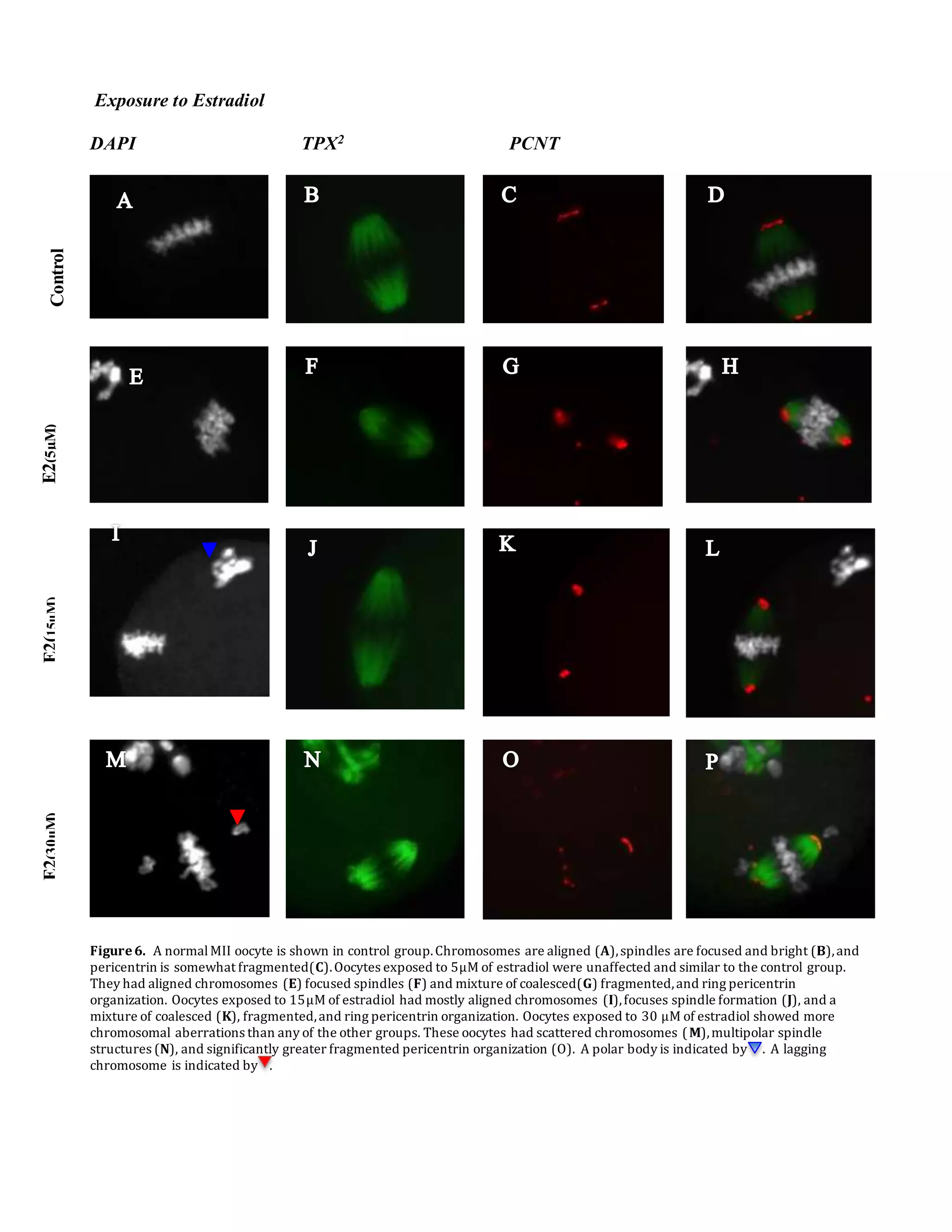 Exposure to Estradiol
DAPI TPX2 PCNT
Figure6. A normalMII oocyte is shown in control group.Chromosomes are aligned (A),spindles are focused and bright (B),and
pericentrin is somewhat fragmented(C).Oocytes exposed to 5µM of estradiol were unaffected and similar to the control group.
They had aligned chromosomes (E) focused spindles (F) and mixture of coalesced(G) fragmented,and ring pericentrin
organization. Oocytes exposed to 15µM of estradiol had mostly aligned chromosomes (I),focuses spindle formation (J), and a
mixture of coalesced (K), fragmented,and ring pericentrin organization. Oocytes exposed to 30 µM of estradiol showed more
chromosomal aberrations than any of the other groups. These oocytes had scattered chromosomes (M),multipolar spindle
structures (N), and significantly greater fragmented pericentrin organization (O). A polar body is indicated by . A lagging
chromosome is indicated by .
ControlE2(15µM)E2(5µM)E2(30µM)
 