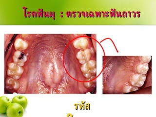 โรคฟันผุ  :  ตรวจเฉพาะฟันถาวร รหัส  0  