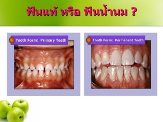 ฟันแท้ หรือ ฟันน้ำนม   ? 