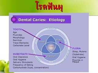 โรคฟันผุ 