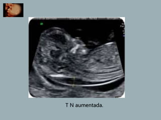 T N aumentada.
 
