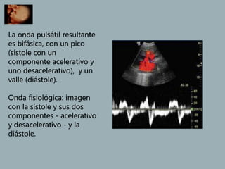 La onda pulsátil resultante
es bifásica, con un pico
(sístole con un
componente acelerativo y
uno desacelerativo), y un
valle (diástole).
Onda fisiológica: imagen
con la sístole y sus dos
componentes - acelerativo
y desacelerativo - y la
diástole.
 