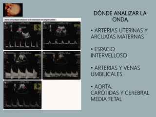 DÓNDE ANALIZAR LA
ONDA
• ARTERIAS UTERINAS Y
ARCUATAS MATERNAS
• ESPACIO
INTERVELLOSO
• ARTERIAS Y VENAS
UMBILICALES
• AORTA,
CARÓTIDAS Y CEREBRAL
MEDIA FETAL
 