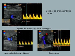 Doppler de arteria umbilical
normal
Doppler de arteria umbilical patológico
ausencia de fin de diástole flujo reverso
 